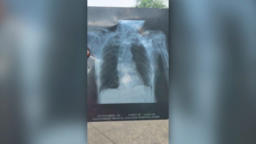 Konni Medical College Wrong Xray Medical Negligence